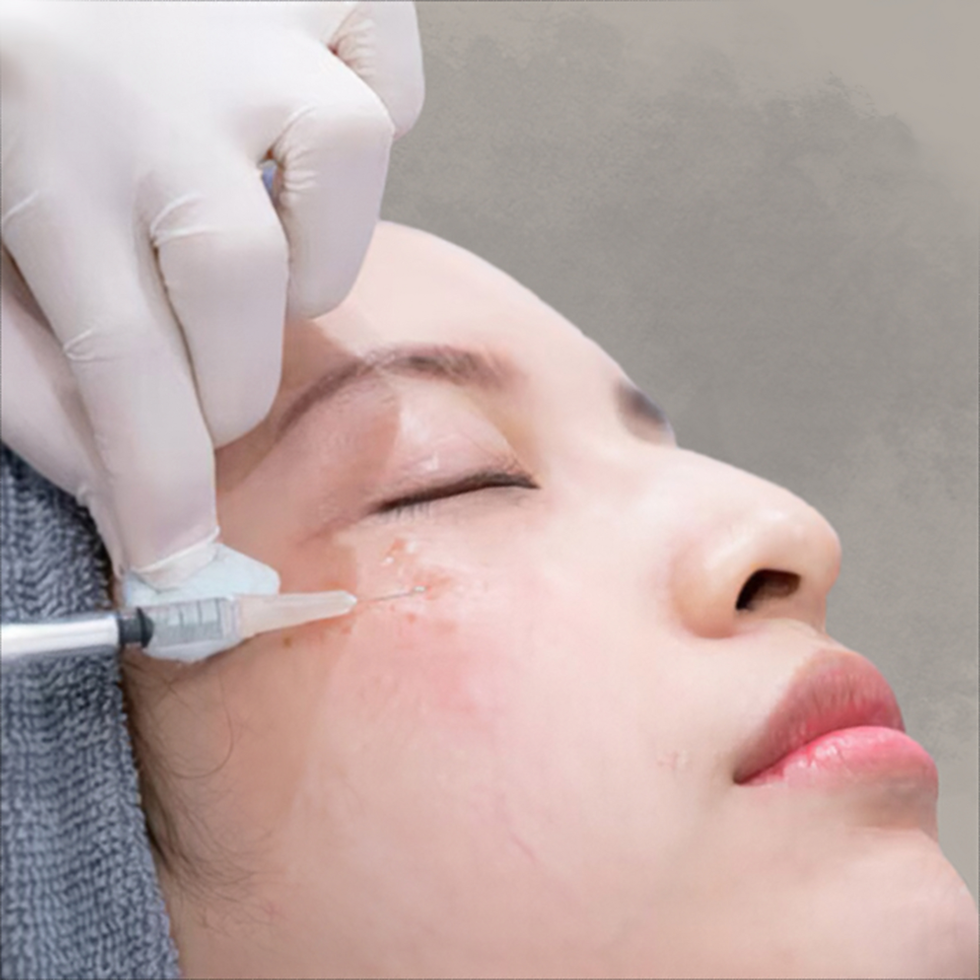 Effectively treat pimples and blemishes with our Pimple Injection treatment at Serenease. Achieve clearer and smoother skin.